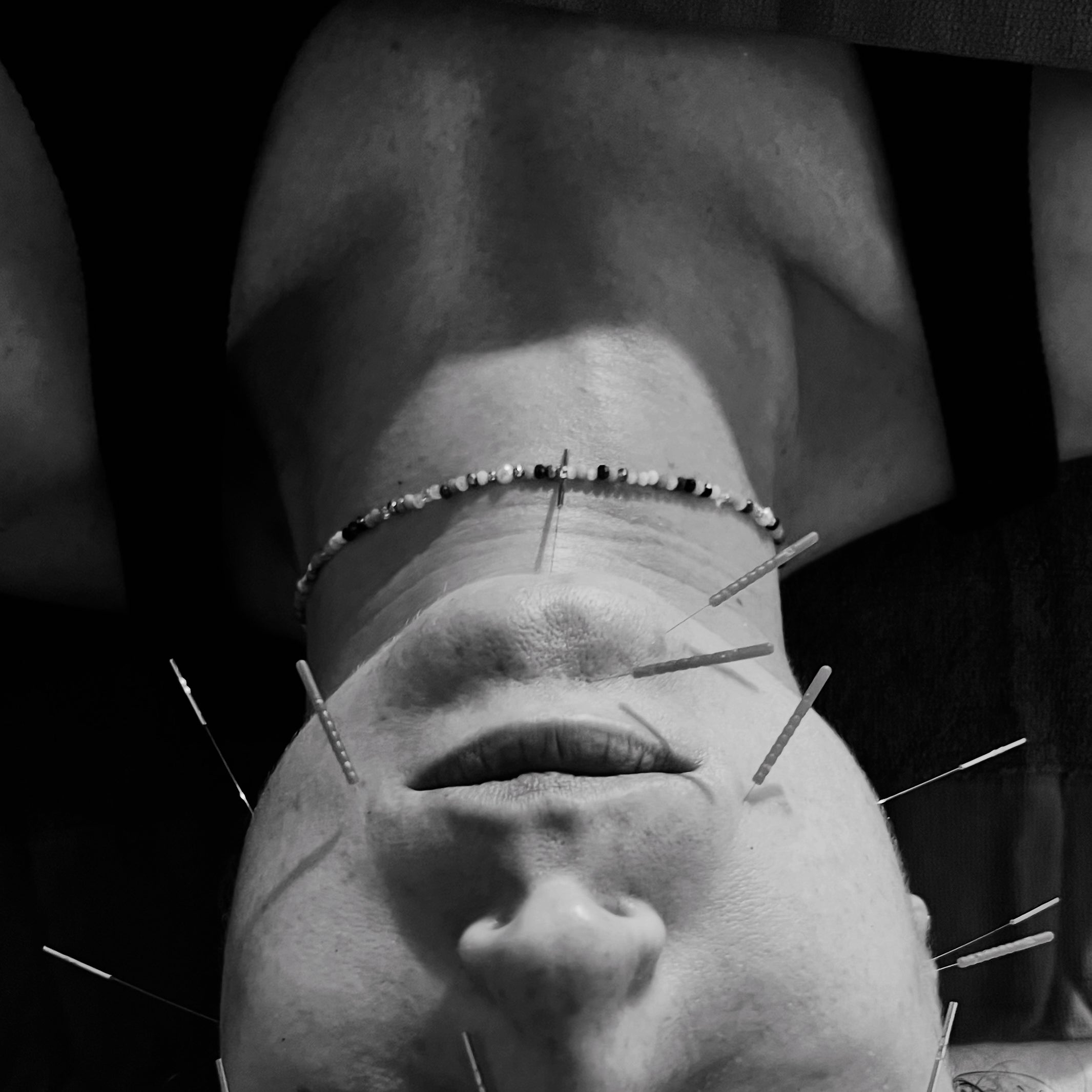 Facial Acupuncture - Initial Treatment